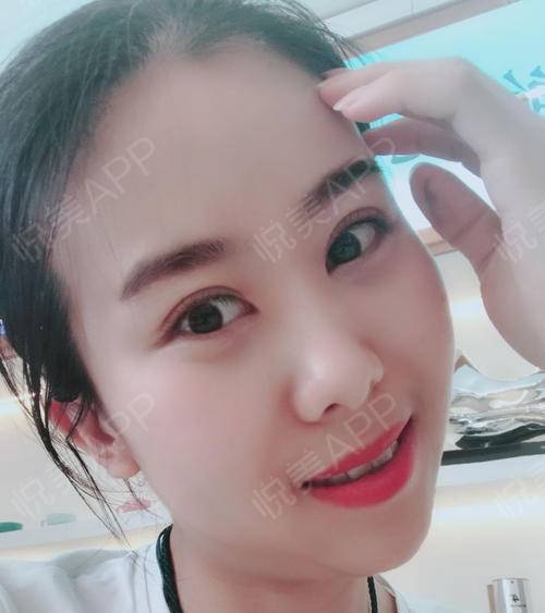 眼睛一点点恢复，越来越好看 眼部多项手术的蜕变之旅